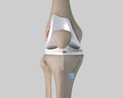 Ayúdame a recuperar mi movilidad gracias a una prótesis de rodilla
